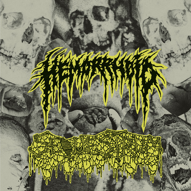 Hemorrhoid